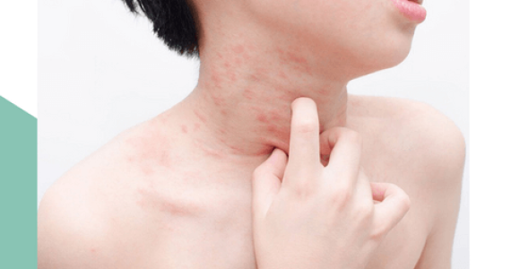 [KHẨN CẤP] Nguyên Nhân Gây Dị Ứng Hải Sản